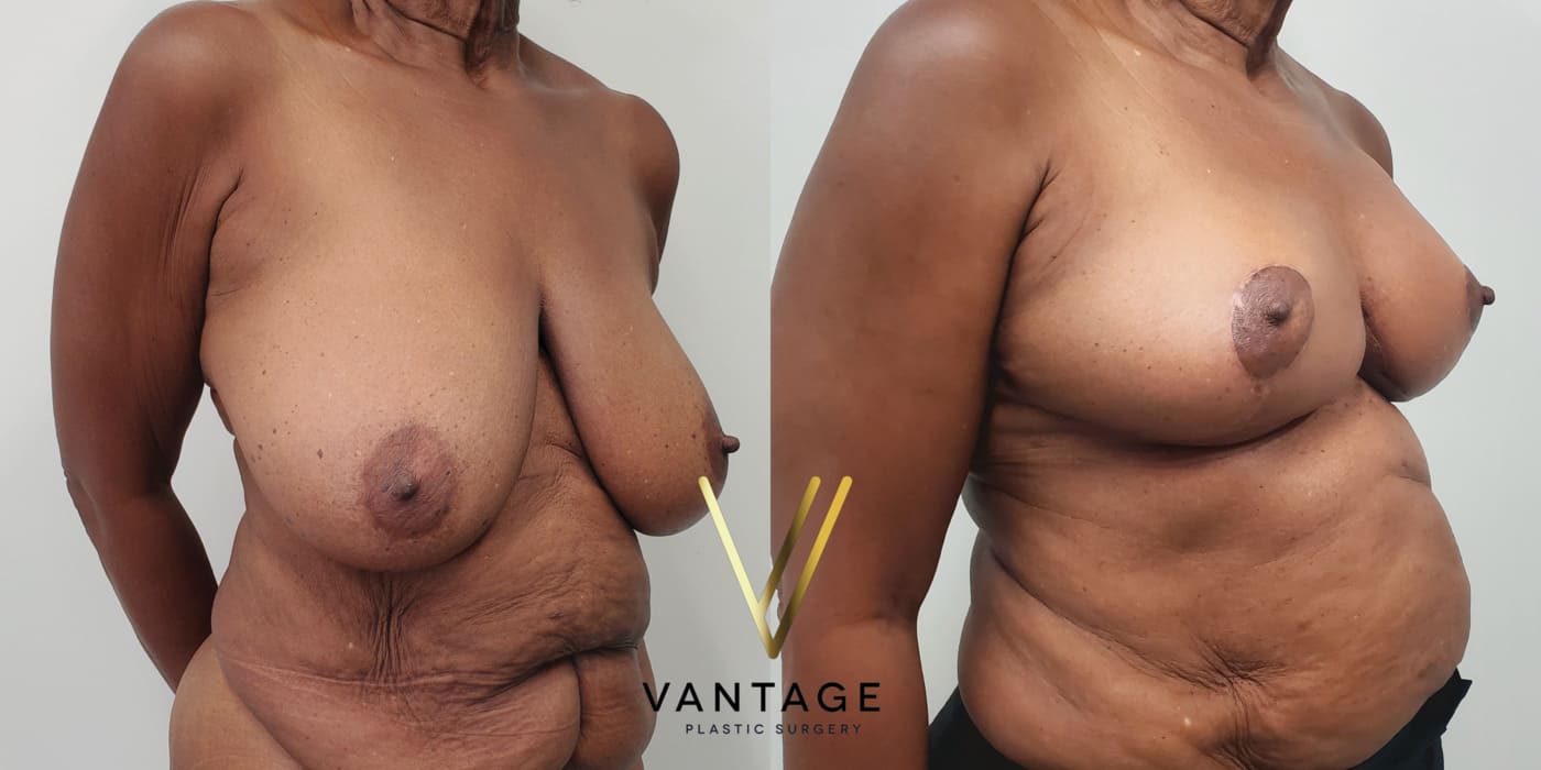 Before and after image of internal bra breast reduction procedure, right oblique view, performed at Vantage Plastic Surgery.