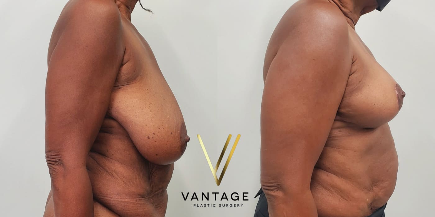 Before and after image of internal bra breast reduction procedure, right view, performed at Vantage Plastic Surgery.