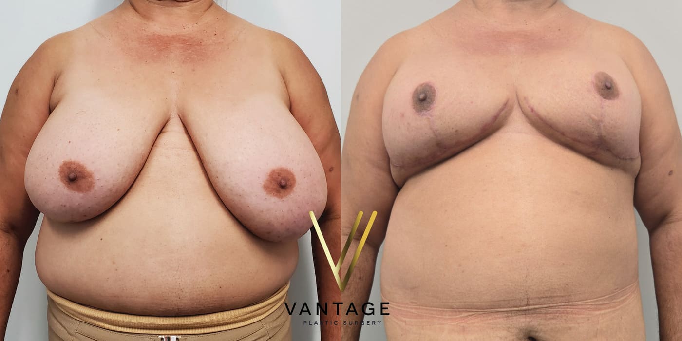 Before and after image of internal bra breast reduction procedure, front view, performed at Vantage Plastic Surgery.