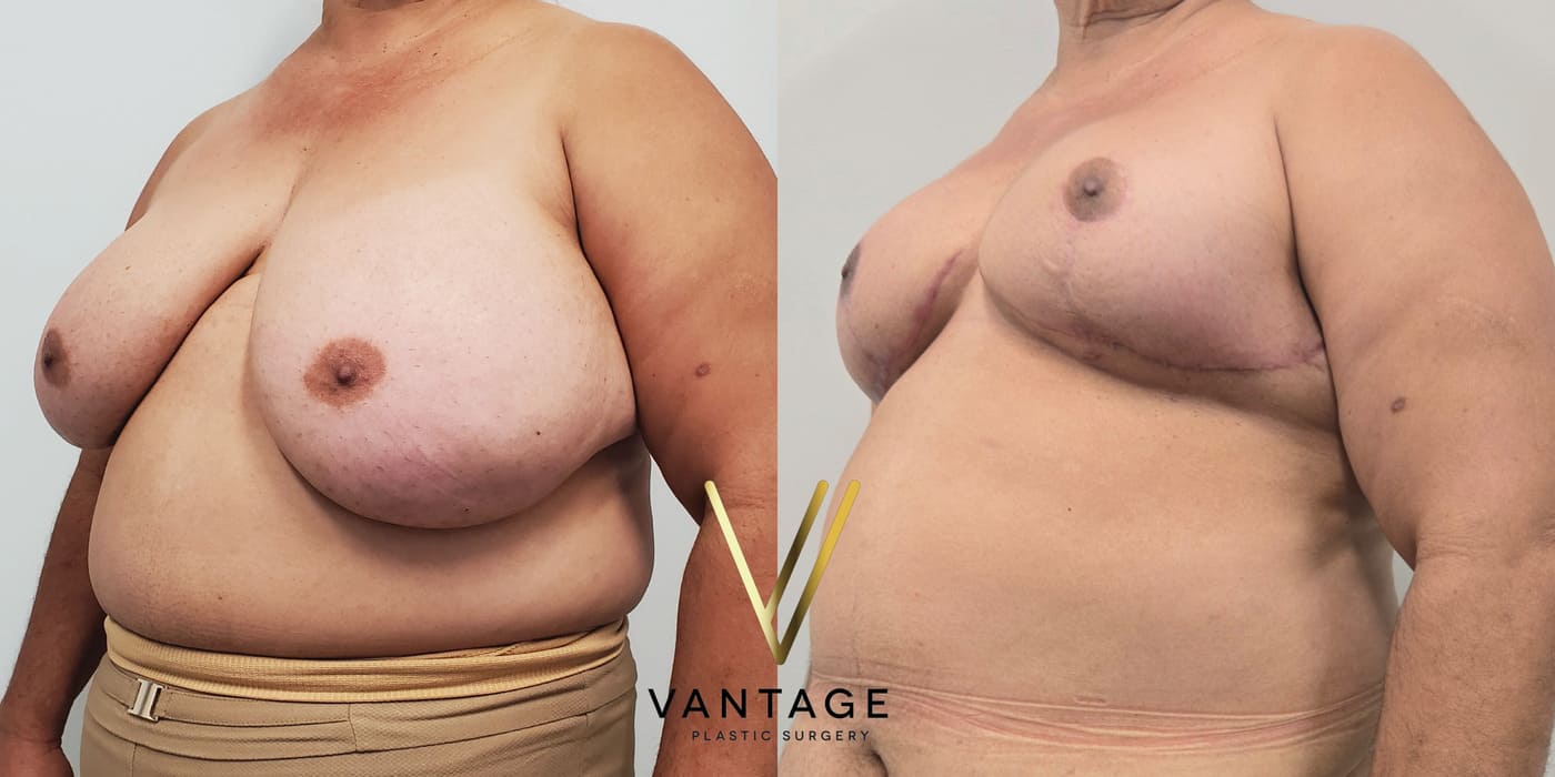 Before and after image of internal bra breast reduction procedure, left oblique view, performed at Vantage Plastic Surgery.