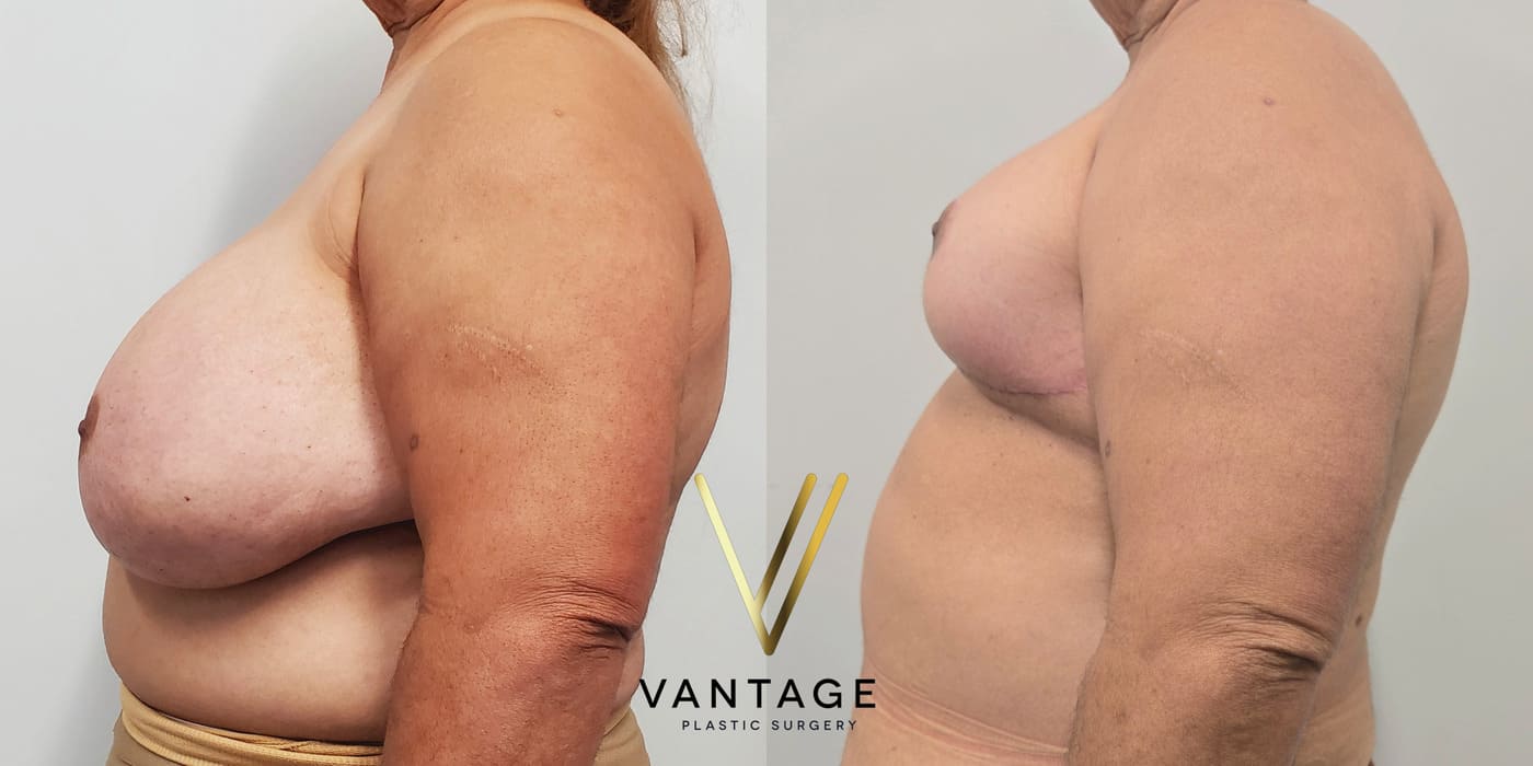 Before and after image of internal bra breast reduction procedure, left view, performed at Vantage Plastic Surgery.