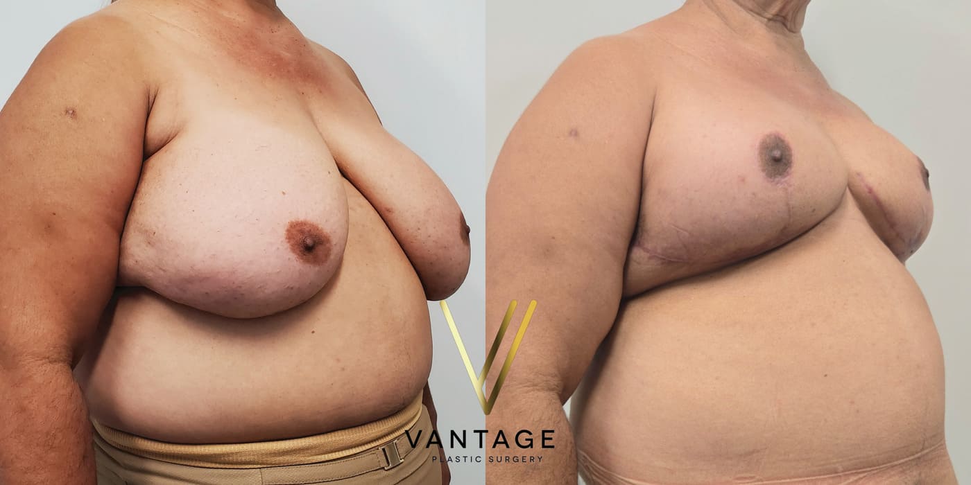 Before and after image of internal bra breast reduction procedure, right oblique view, performed at Vantage Plastic Surgery.