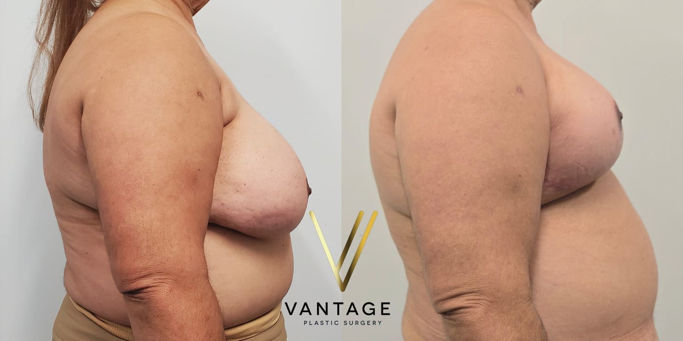 Before and after image of internal bra breast reduction procedure, right view, performed at Vantage Plastic Surgery.