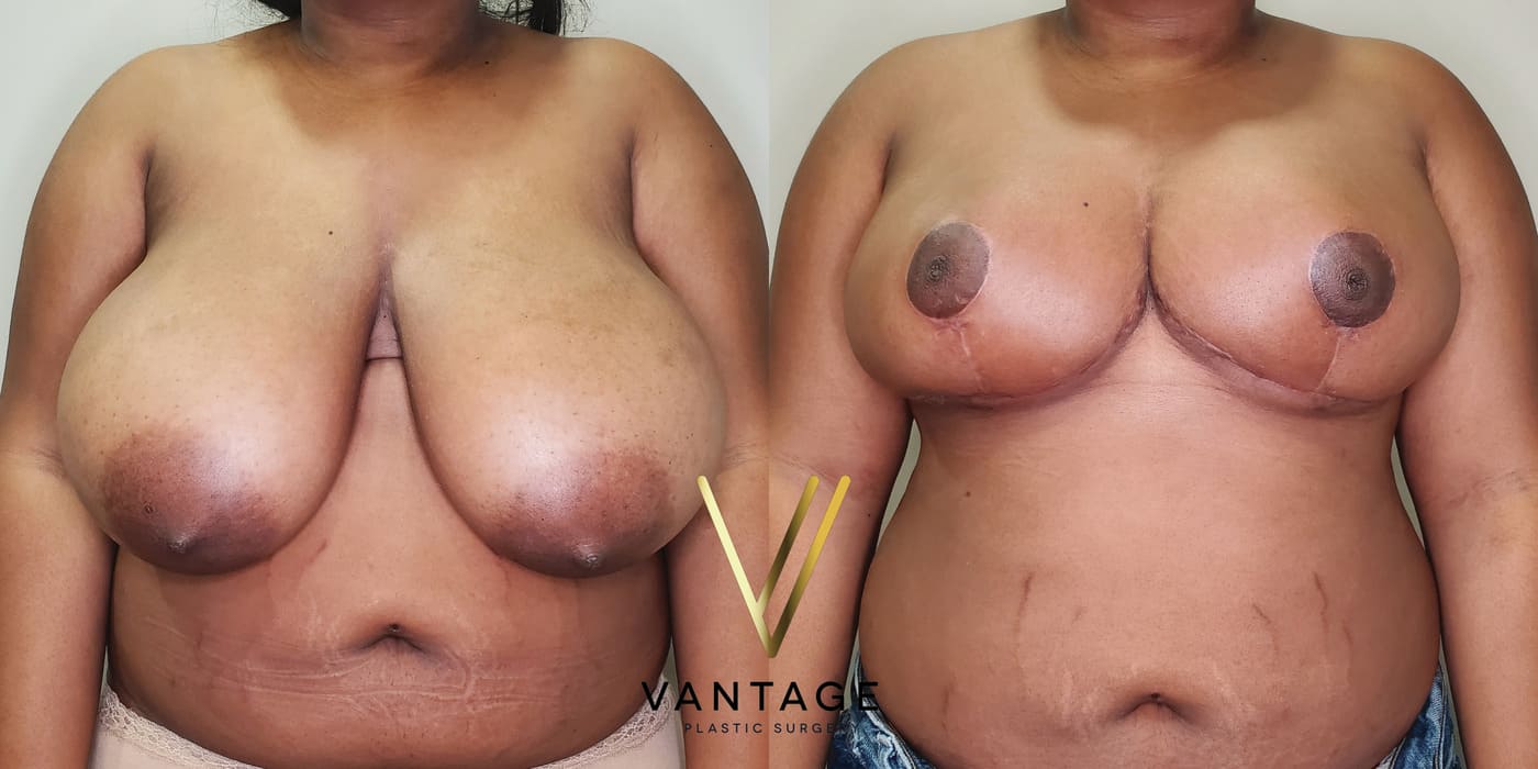 Before and after image of internal bra breast reduction procedure, front view, performed at Vantage Plastic Surgery.