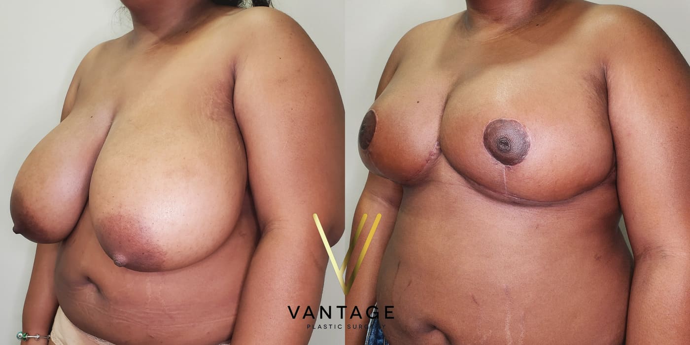 Before and after image of internal bra breast reduction procedure, left oblique view, performed at Vantage Plastic Surgery.