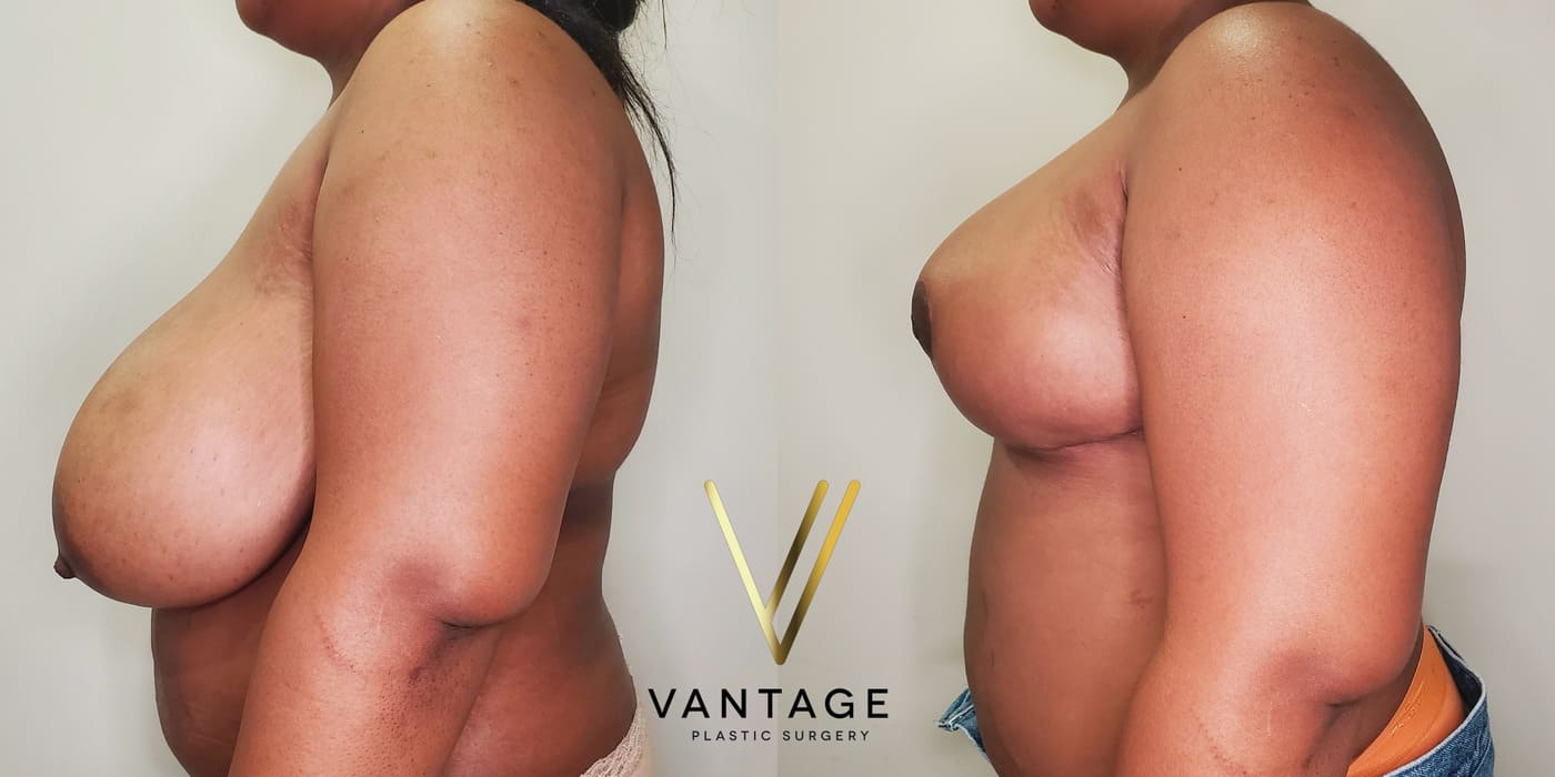 Before and after image of internal bra breast reduction procedure, left view, performed at Vantage Plastic Surgery.