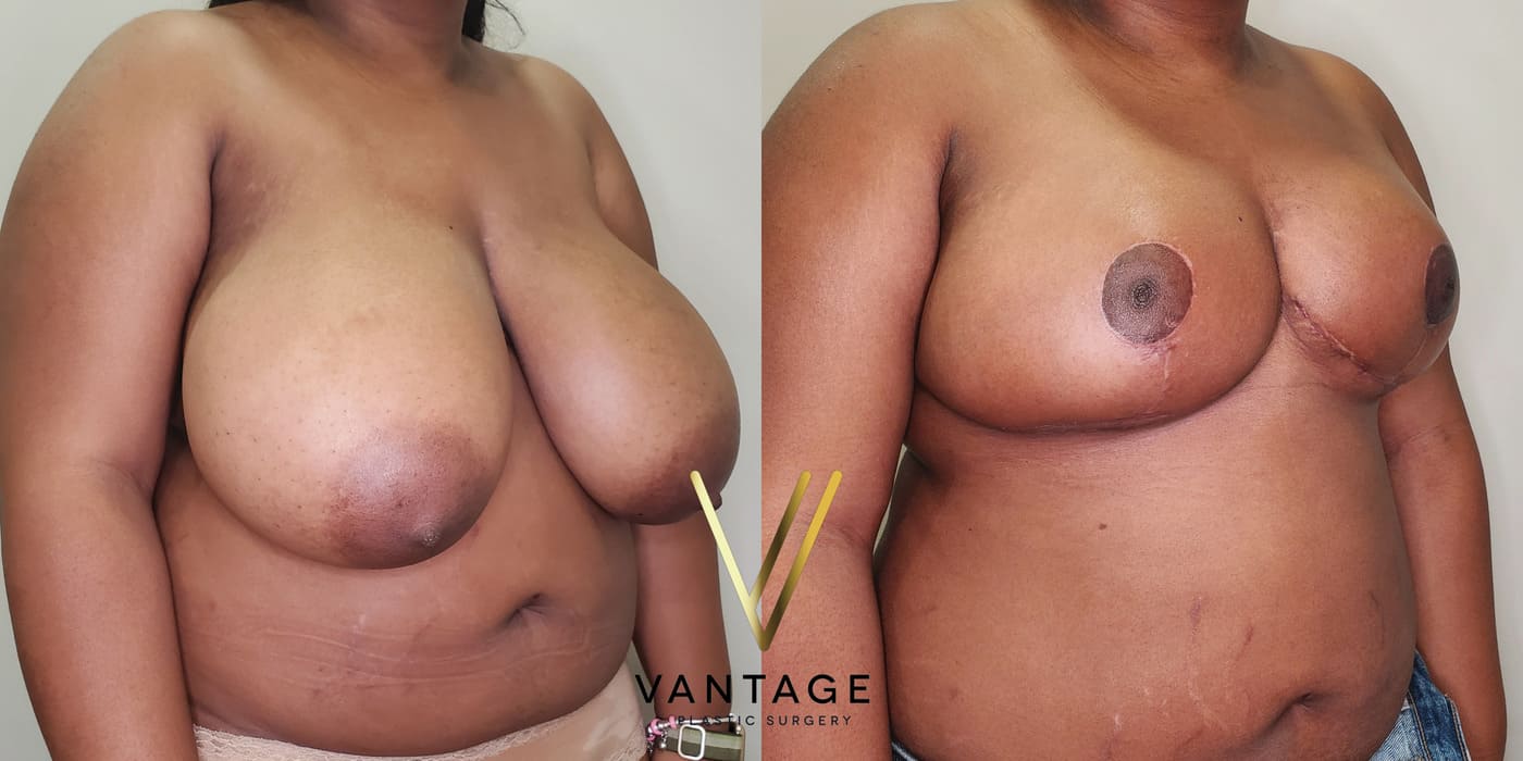 Before and after image of internal bra breast reduction procedure, right oblique view, performed at Vantage Plastic Surgery.