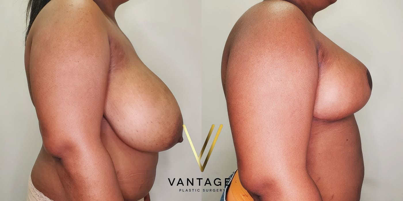 Before and after image of internal bra breast reduction procedure, right view, performed at Vantage Plastic Surgery.