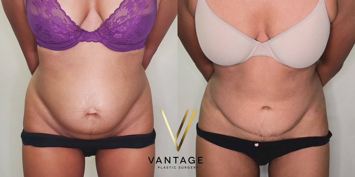 patient before and after abdominoplasty