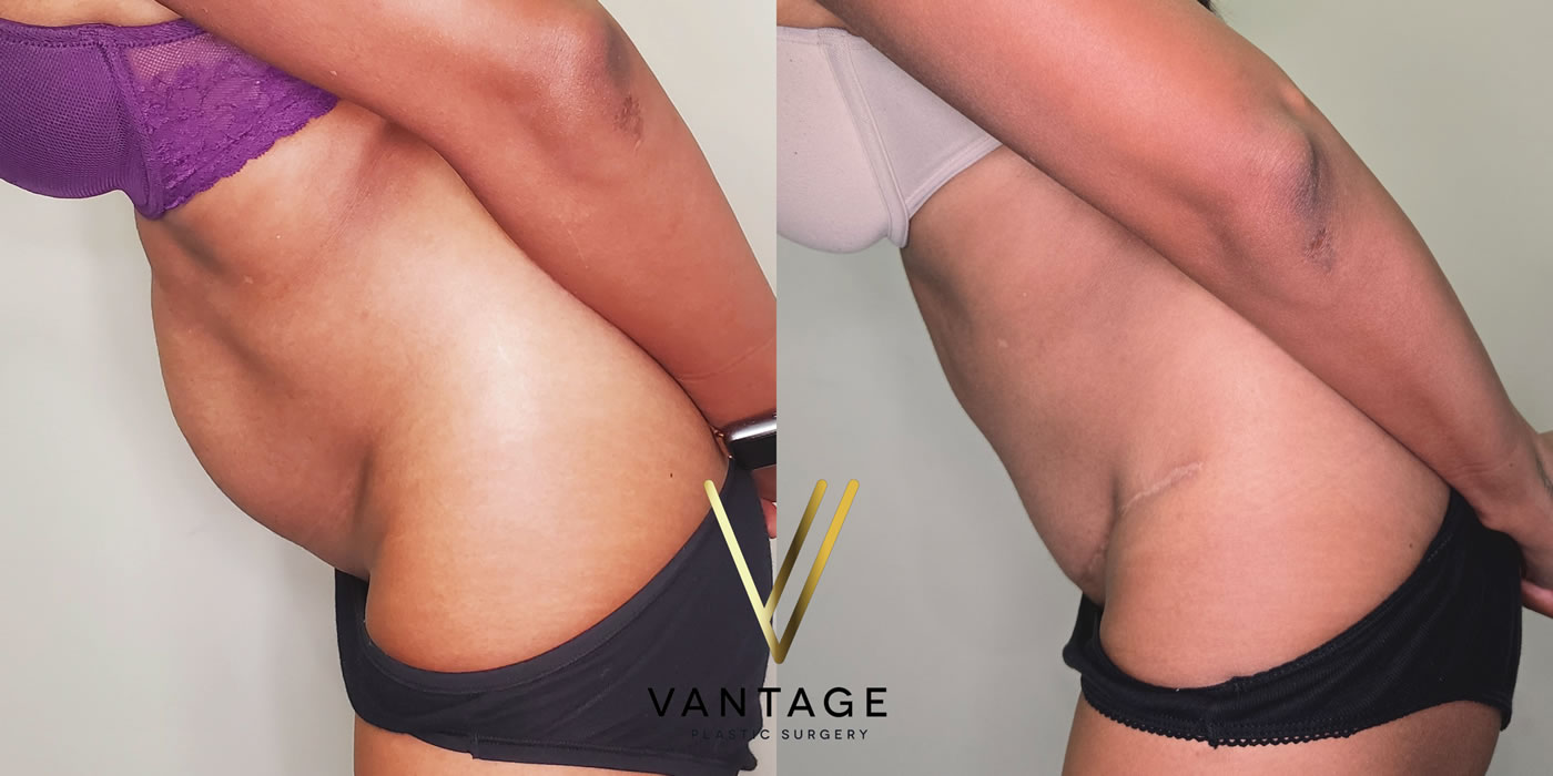 patient before and after abdominoplasty