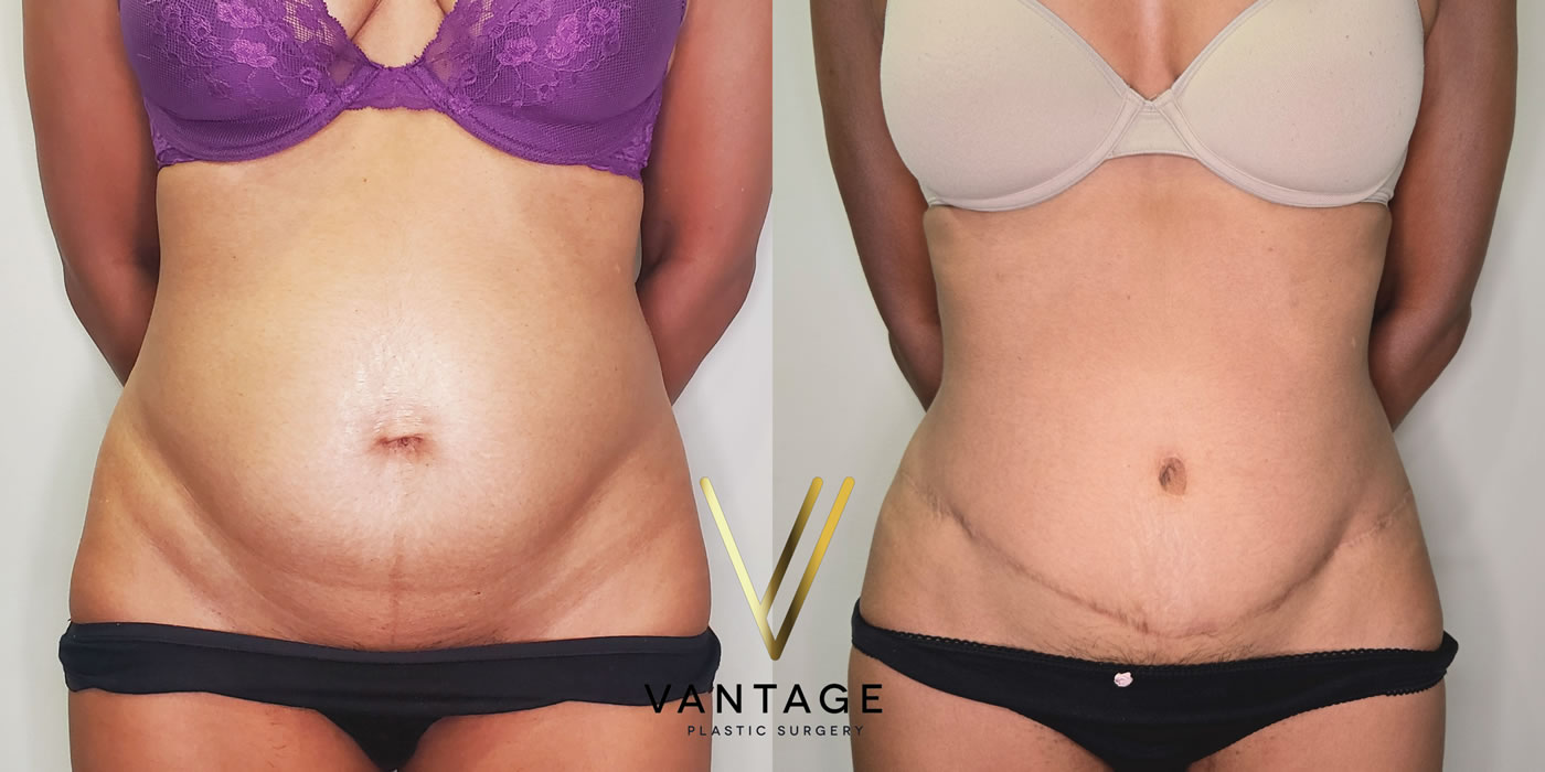 patient before and after abdominoplasty