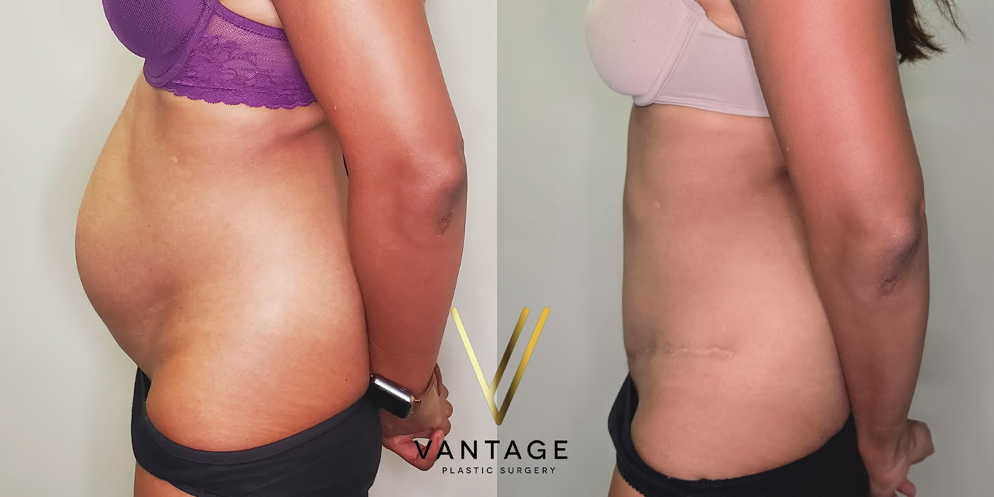 patient before and after abdominoplasty