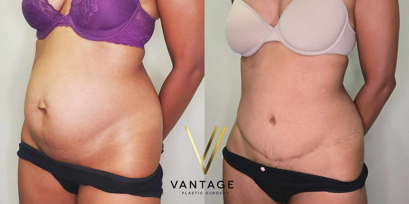 patient before and after abdominoplasty