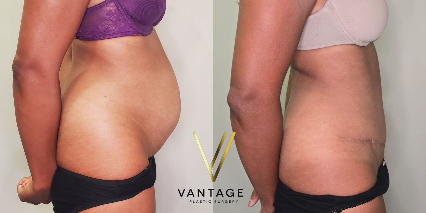 patient before and after abdominoplasty