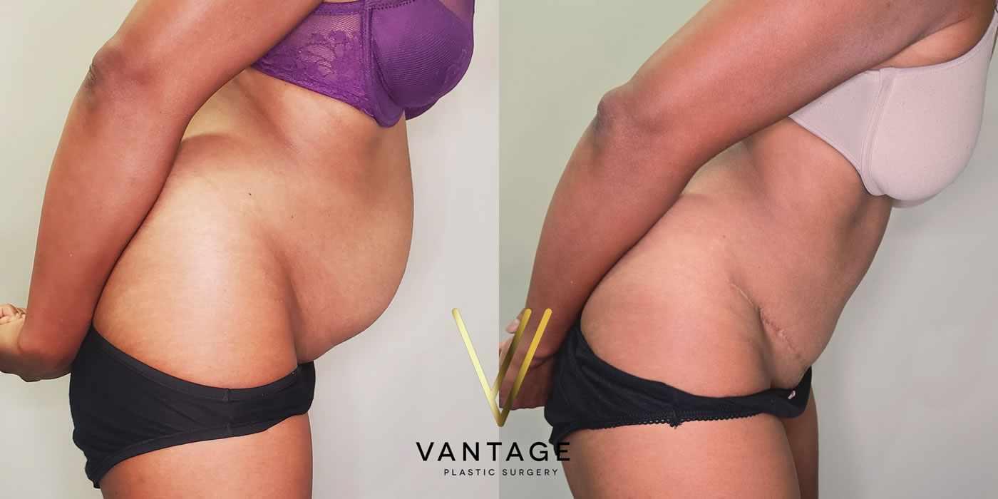 patient before and after abdominoplasty