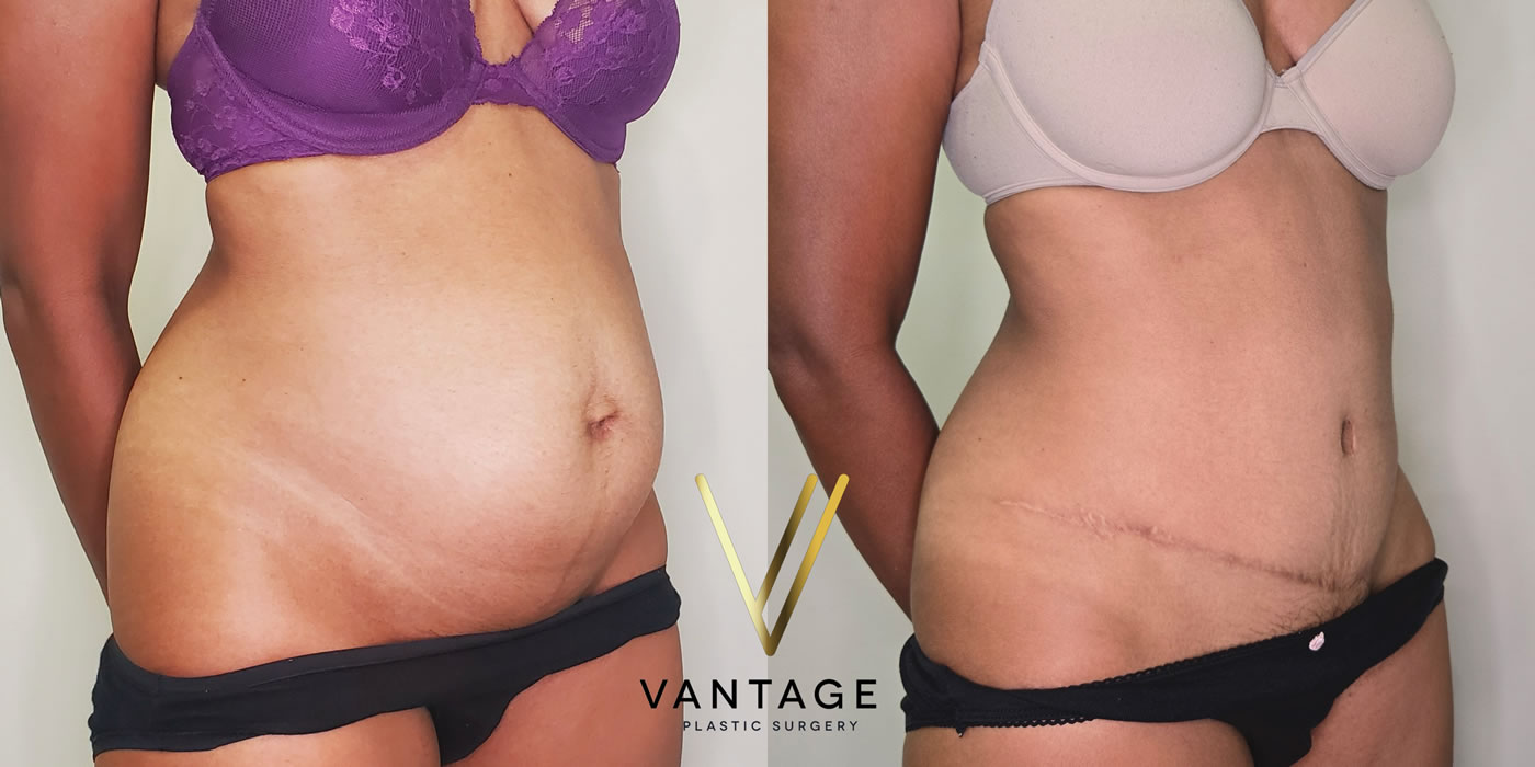 patient before and after abdominoplasty