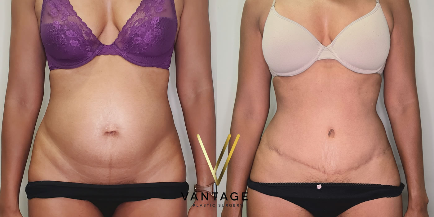 patient before and after abdominoplasty